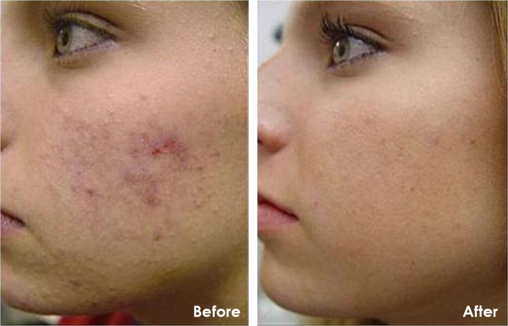 Chemical Peels