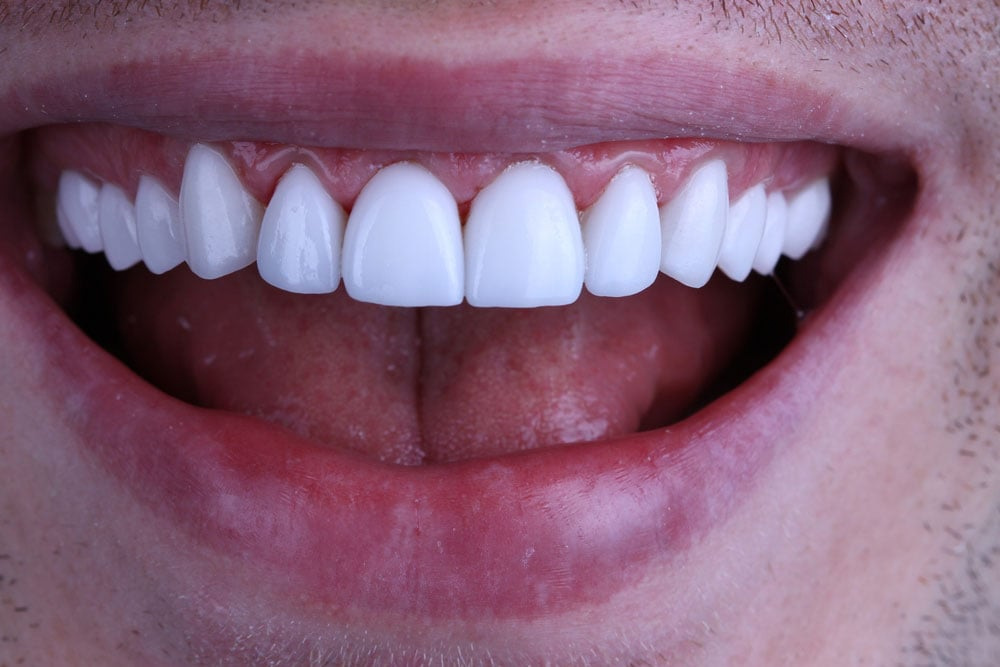 Hollywood Smile (Veneers)