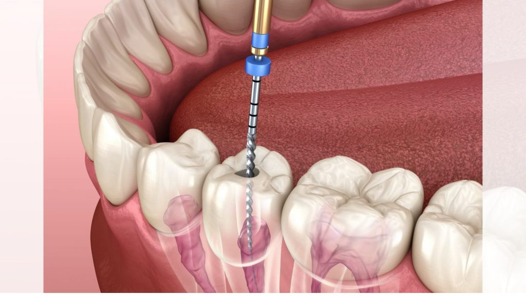 Single-Seating Root Canal