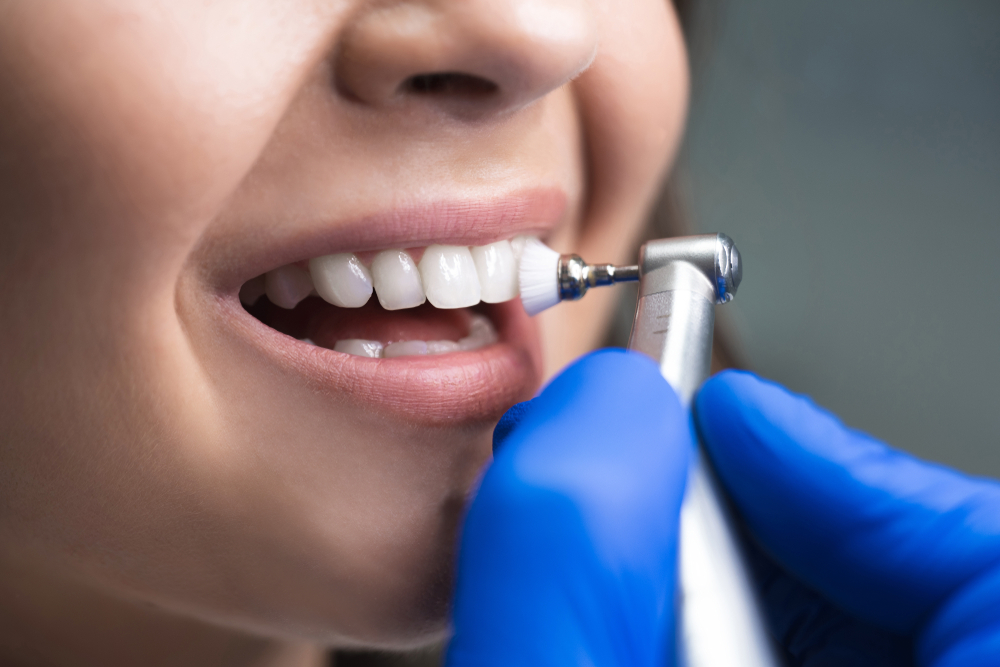 Dental Scaling and Polishing